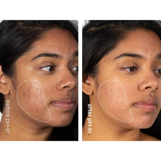 Set rutina de ingrijire a tenului sensibil sau acneic in 3 pasi, pH-In Healthy Skin System, Indeed Labs, 3 articole