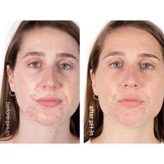 Set rutina de ingrijire a tenului sensibil sau acneic in 3 pasi, pH-In Healthy Skin System, Indeed Labs, 3 articole