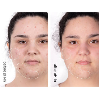 Set rutina de ingrijire a tenului sensibil sau acneic in 3 pasi, pH-In Healthy Skin System, Indeed Labs, 3 articole