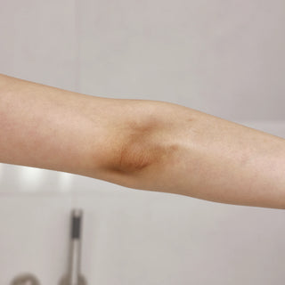 Close-up of a person's bent elbow and forearm, showing a brown tinted patch or bruise-like discoloration on the inner elbow area, against a light neutral indoor background.