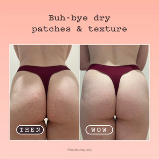 Before-and-after comparison showing the back of a woman's buttocks with red dry patches and texture in the 'THEN' panel and clearer skin in the 'WOW' panel, under the headline 'Buh-bye dry patches & texture'.