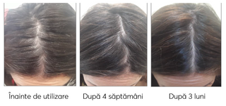 Tratament impotriva incaruntirii si caderii parului Ageless Clinic Treatment Plus, Rut Hair, 210 ml