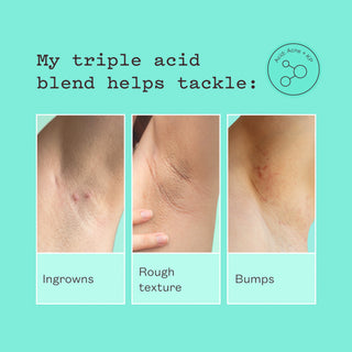 A promotional graphic on a mint green background with text reading 'My triple acid blend helps tackle:' and three inset close-up photos of skin showing ingrown marks, rough texture, and bumps. A circular logo at top right says 'Acid Acne + AHA'.