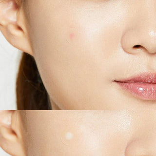 Plasturi hidrocoloidali impotriva acneei Acne Pimple, COSRX, 24 buc. Tuju -