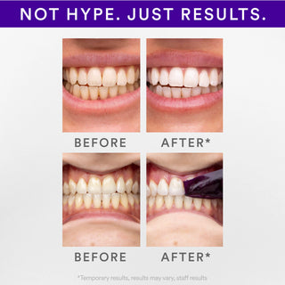 Hismile V34 set benzi pentru albirea dintilor, 14 aplicari